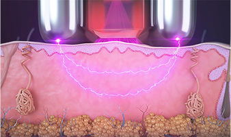 Sublime® ապլիկատոր
